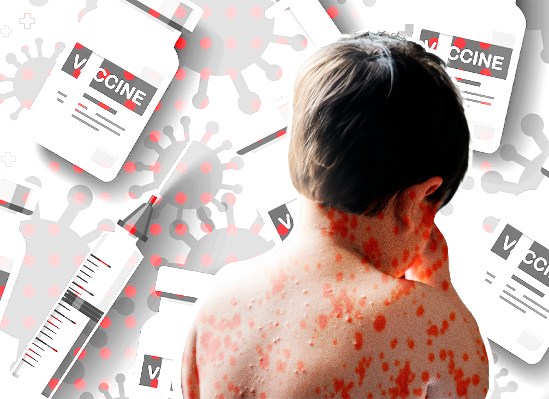 Niño con sarampión